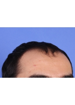 Before Hair Transplant&nbsp;Front